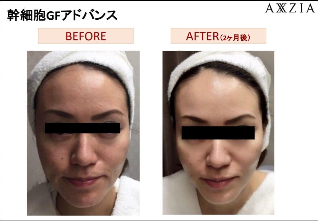 【本物】アクシージア☆GFチャージアドバンス☆美容液導入美肌艶肌水光注射エステ